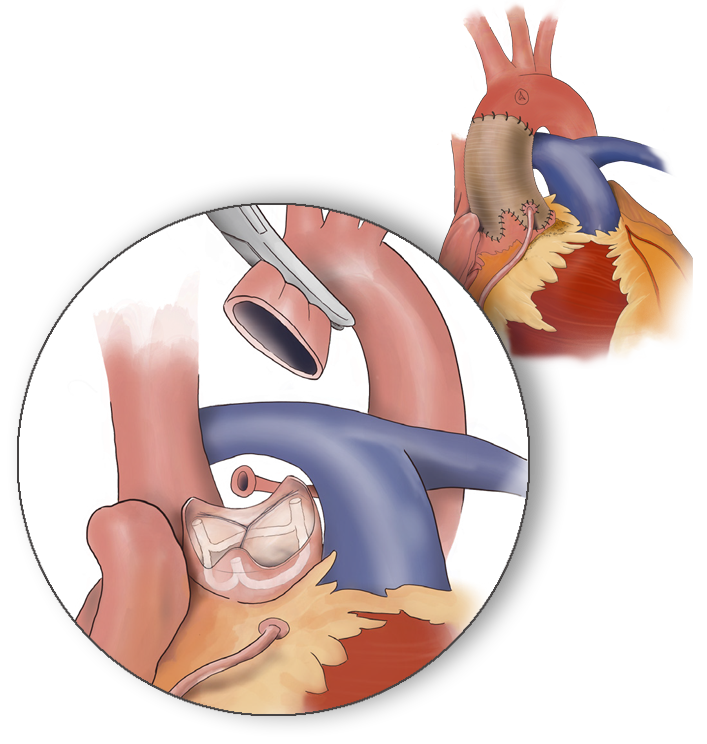 Aortic Root Restoration