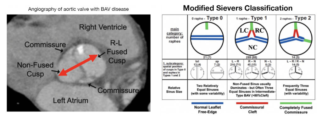 Angiography image of aortic valve with BAV disease and chart of Modified Sievers Classification