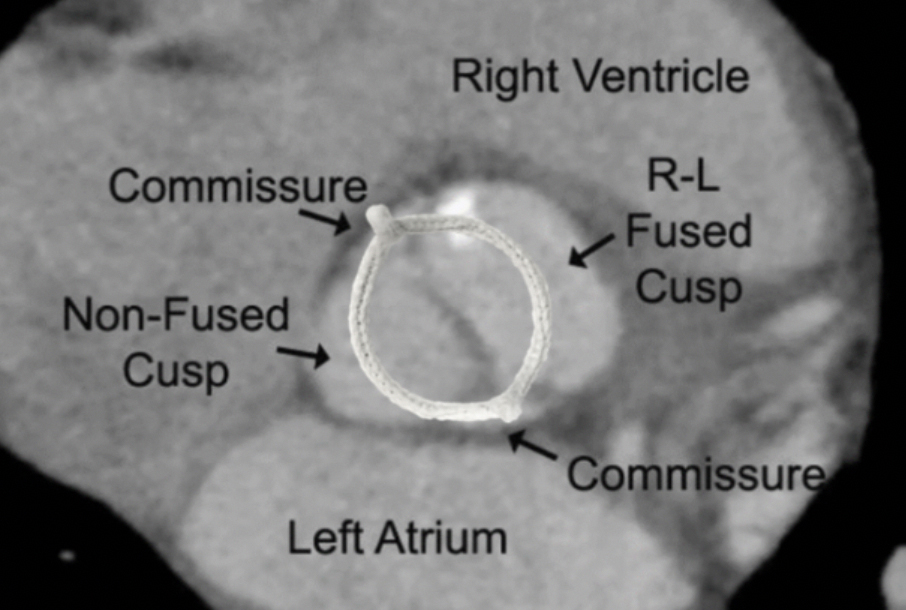 HAART 200 simplifying BAV repair with three-dimensional annuloplasty