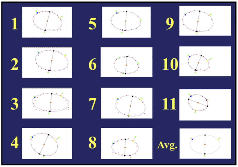 Aortic valve geometry observed in 11 patients with normal valves