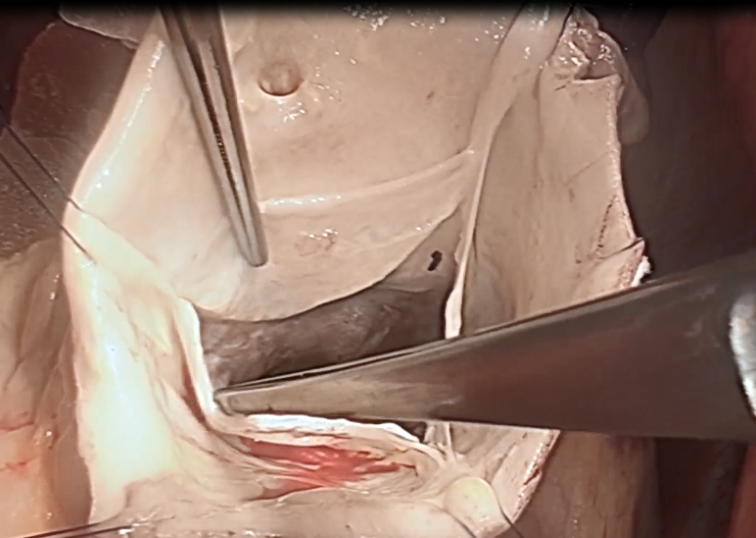 Aortic Valve Repair and Selective Sinus Remodeling for Aortic Root Aneurysm