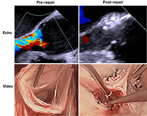 Echocardiographic and video images of the aortic valve before and after the repair