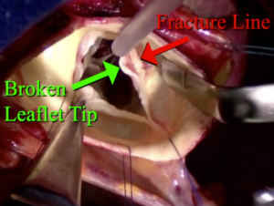 Bicuspid repair with the HAART 200 Annuloplasty Device